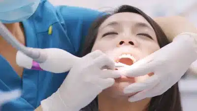 Manfaat Scalling Gigi untuk Membersihkan Karang Gigi