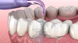 Manfaat Scalling Gigi untuk Membersihkan Karang Gigi