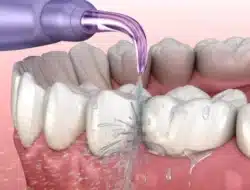 Manfaat Scaling Gigi untuk Menjaga Kesehatan Mulut