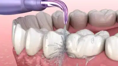 Manfaat Scalling Gigi untuk Membersihkan Karang Gigi