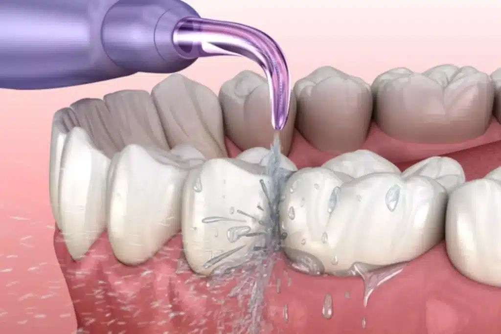 Manfaat Scalling Gigi untuk Membersihkan Karang Gigi